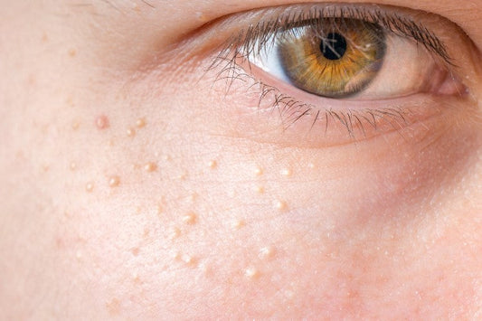Facial Keratosis Pilaris? Here’s the Skincare Routine That Works